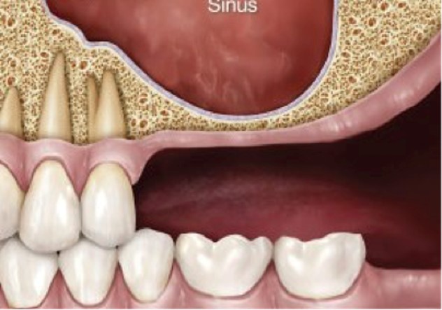 SINUS LIFTS OR SINUS BYPASS - DENTAL IMPLANT SPECIALITY CENTRE