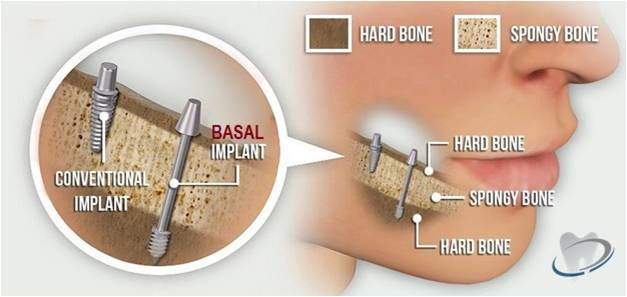 Basal Iplants – DENTAL IMPLANT SPECIALITY CENTRE