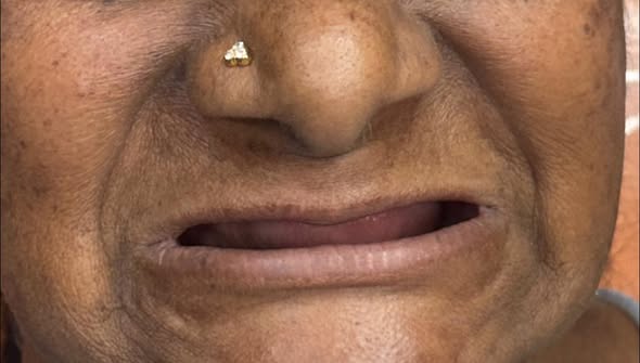 A New Smile in Just Days