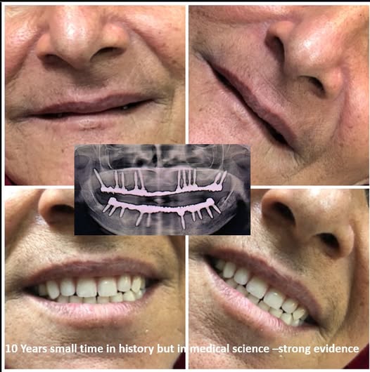 long-term success and stability of cortico-basal immediate load dental implants over a 10-year period.