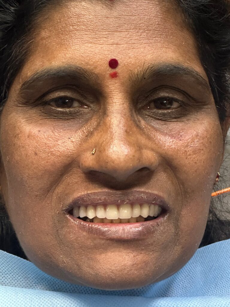 the final outcome of treatment, highlighting improved smile, esthetics, and patient confidence after implant rehabilitation.