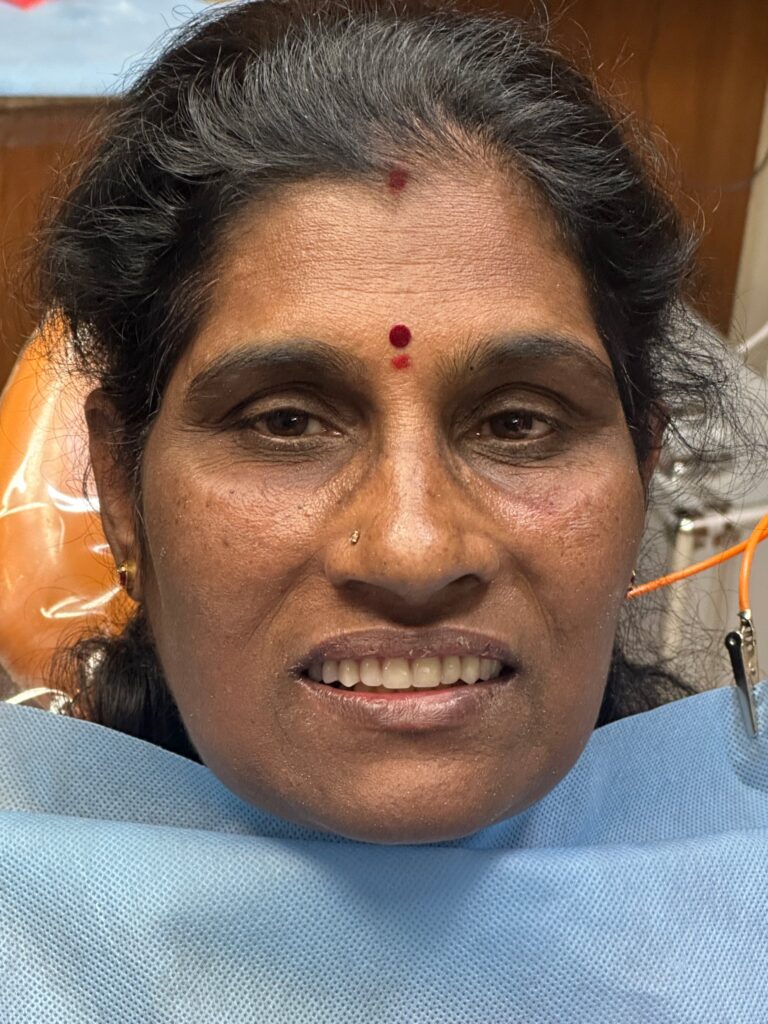 the final outcome of treatment, highlighting improved smile, esthetics, and patient confidence after implant rehabilitation.