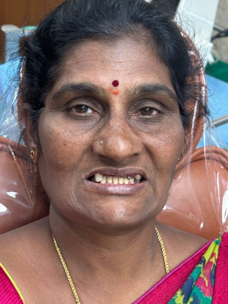 initial clinical condition, showing missing teeth and functional limitations.