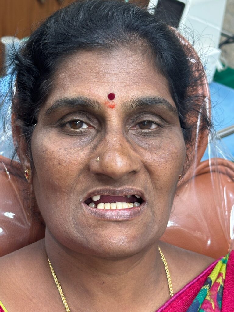 initial clinical condition, showing missing teeth and functional limitations.